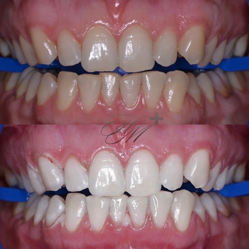 Отбеливание зубов, до и после