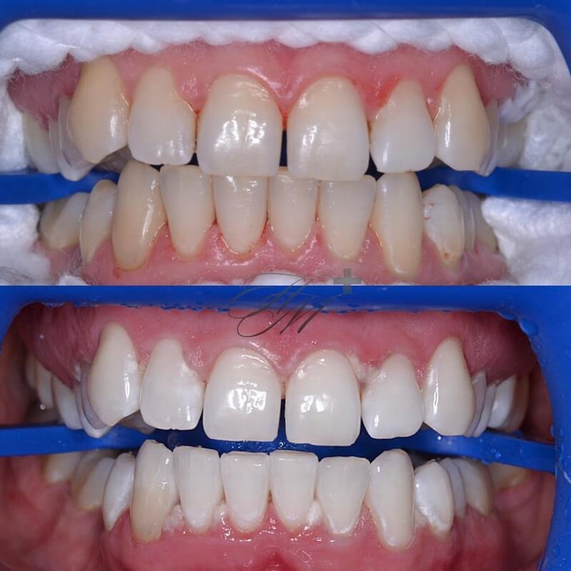 Zoom отбеливание зубов до и после фото купить сменные насадки для зубной щетки филипс